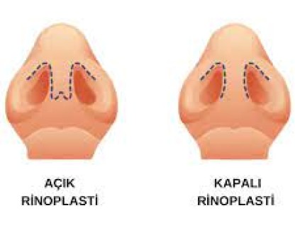 Açık Ve Kapalı Rinoplasti Farkı Nedir